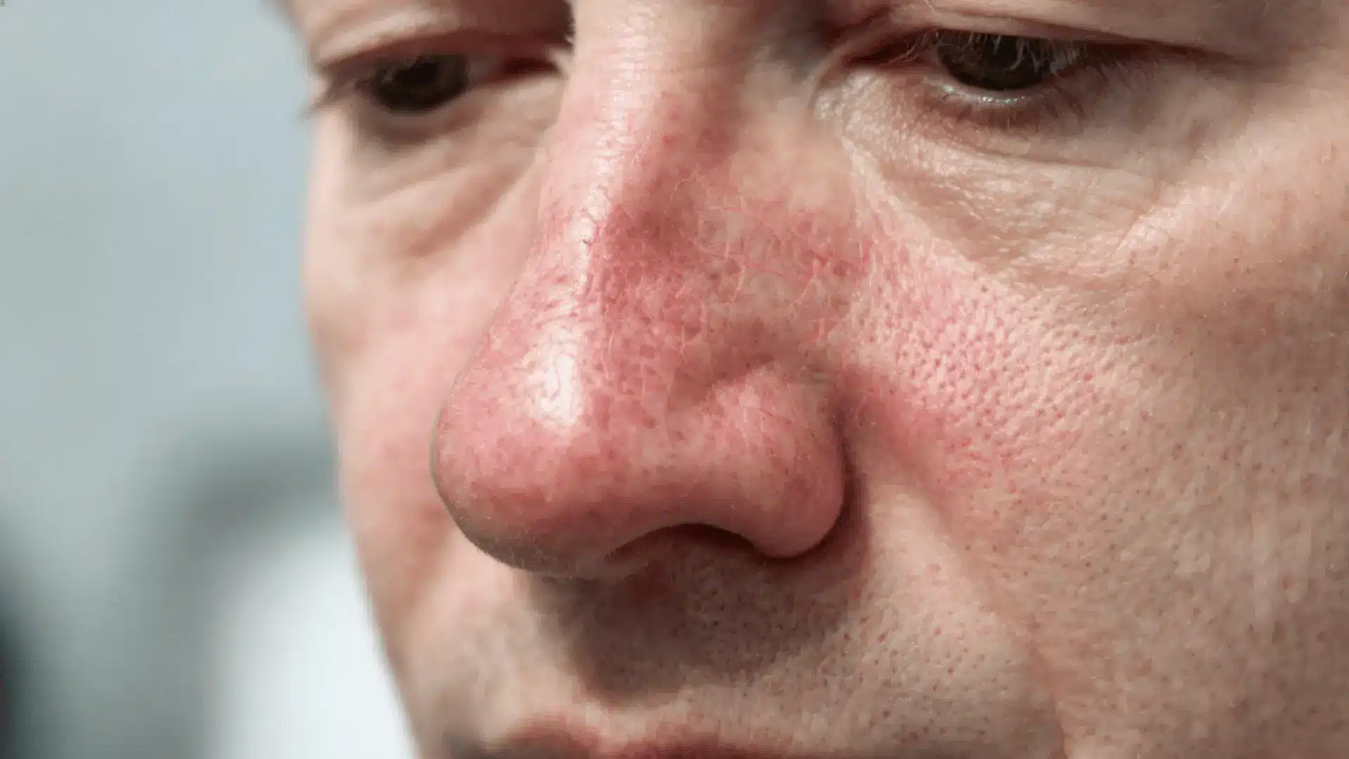 close view of a red nose with visible pores and mild facial flushing