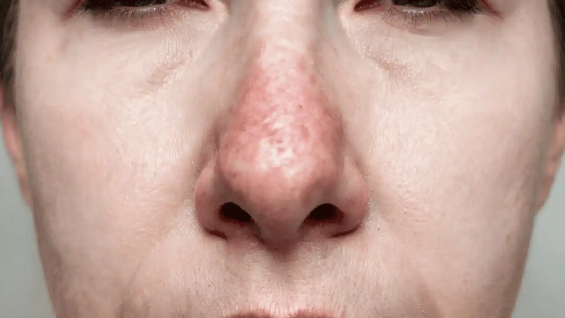 macro close up of a flushed nose and cheeks after alcohol related redness